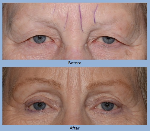 eye eyelid eyelids blepharoplasty surgery before and after photos - Neal D. Goldman, M.D. - Facial Plastic Surgeon - Goldman Center for Facial Plastic Surgery