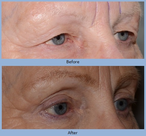eye eyelid eyelids blepharoplasty surgery before and after photos - Neal D. Goldman, M.D. - Facial Plastic Surgeon - Goldman Center for Facial Plastic Surgery