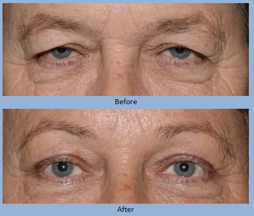 eye eyelid eyelids blepharoplasty surgery before and after photos - Neal D. Goldman, M.D. - Facial Plastic Surgeon - Goldman Center for Facial Plastic Surgery