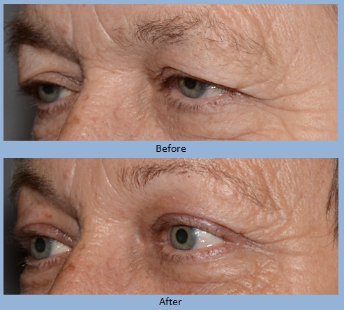 eye eyelid eyelids blepharoplasty surgery before and after photos - Neal D. Goldman, M.D. - Facial Plastic Surgeon - Goldman Center for Facial Plastic Surgery