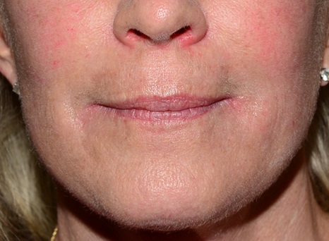 Fractional CO2 Laser - After Treatment