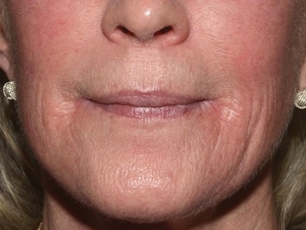 Fractional CO2 Laser - Before Treatment