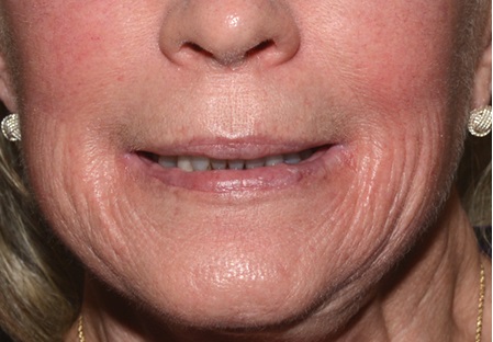 Fractional CO2 Laser - Before Treatment