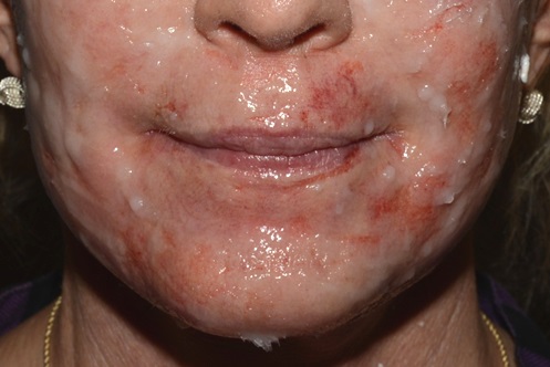 Fractional CO2 Laser - Immediately After Treatment