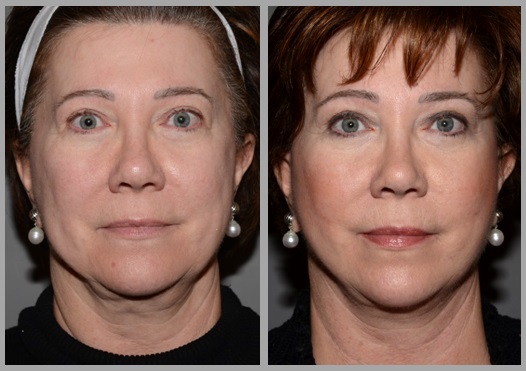 Facelift Necklift Before After - Neal D. Goldman, M.D. - Facial Plastic Surgeon - Goldman Center for Facial Plastic Surgery