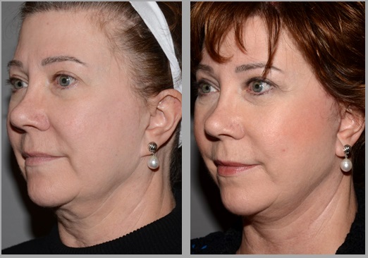 Facelift Necklift Before After - Neal D. Goldman, M.D. - Facial Plastic Surgeon - Goldman Center for Facial Plastic Surgery