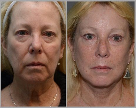 Facelift Necklift Before After - Neal D. Goldman, M.D. - Facial Plastic Surgeon - Goldman Center for Facial Plastic Surgery