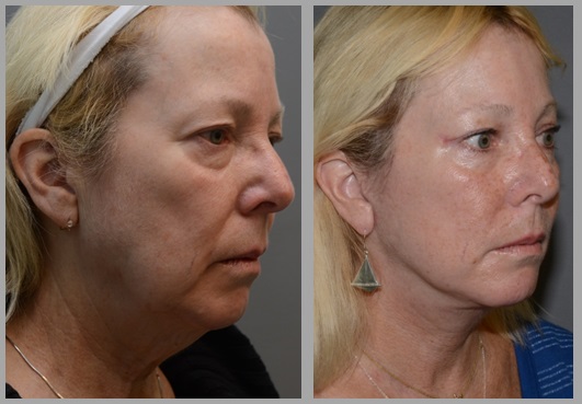 Facelift Necklift Before After - Neal D. Goldman, M.D. - Facial Plastic Surgeon - Goldman Center for Facial Plastic Surgery