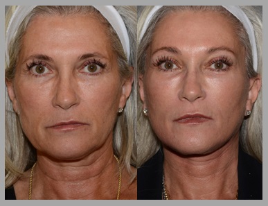 Facelift Necklift Before After - Neal D. Goldman, M.D. - Facial Plastic Surgeon - Goldman Center for Facial Plastic Surgery