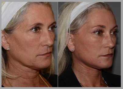 Facelift Necklift Before After - Neal D. Goldman, M.D. - Facial Plastic Surgeon - Goldman Center for Facial Plastic Surgery