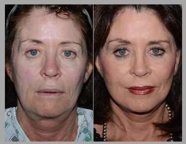 Facelift Necklift Before After - Neal D. Goldman, M.D. - Facial Plastic Surgeon - Goldman Center for Facial Plastic Surgery