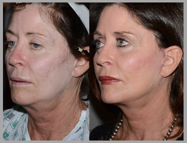 Facelift Necklift Before After - Neal D. Goldman, M.D. - Facial Plastic Surgeon - Goldman Center for Facial Plastic Surgery