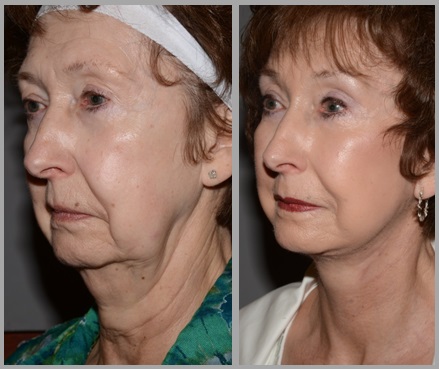 Facelift Necklift Before After - Neal D. Goldman, M.D. - Facial Plastic Surgeon - Goldman Center for Facial Plastic Surgery