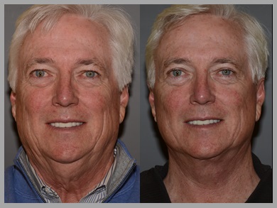 Facelift Necklift Before After - Neal D. Goldman, M.D. - Facial Plastic Surgeon - Goldman Center for Facial Plastic Surgery