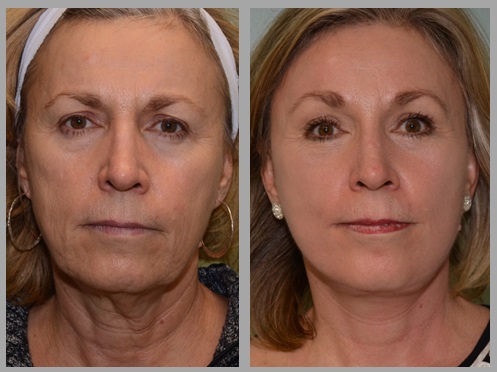 Facelift Necklift Before After - Neal D. Goldman, M.D. - Facial Plastic Surgeon - Goldman Center for Facial Plastic Surgery