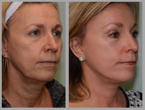 Facelift Necklift Before After - Neal D. Goldman, M.D. - Facial Plastic Surgeon - Goldman Center for Facial Plastic Surgery