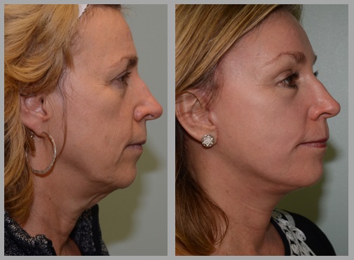 Facelift Necklift Before After - Neal D. Goldman, M.D. - Facial Plastic Surgeon - Goldman Center for Facial Plastic Surgery