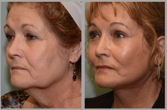 Facelift Necklift Before After - Neal D. Goldman, M.D. - Facial Plastic Surgeon - Goldman Center for Facial Plastic Surgery