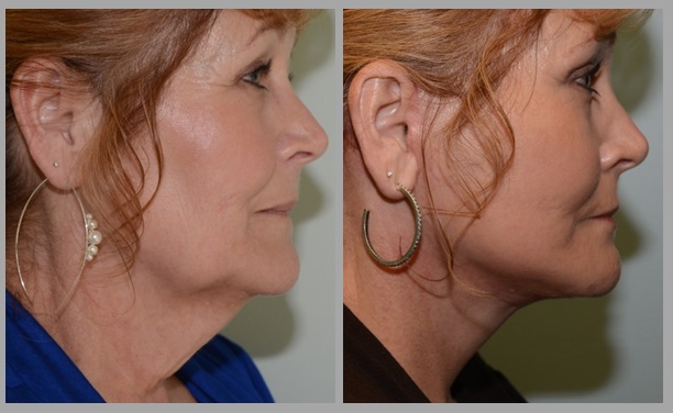 Facelift Necklift Before After - Neal D. Goldman, M.D. - Facial Plastic Surgeon - Goldman Center for Facial Plastic Surgery