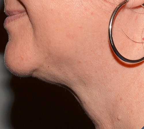 Kybella After - Neal D Goldman, M.D. - Facial Plastic Surgeon - Goldman Center for Facial Plastic Surgery