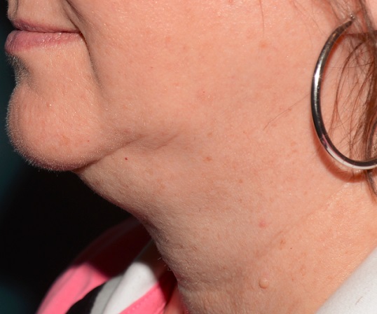 Kybella Before - Neal D Goldman, M.D. - Facial Plastic Surgeon - Goldman Center for Facial Plastic Surgery