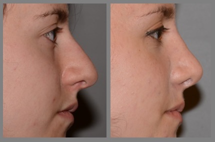 Rhinoplasty - Neal D. Goldman, M.D. - Facial Plastic Surgeon - Goldman Center for Facial Plastic Surgery