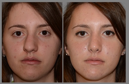 Rhinoplasty - Neal D. Goldman, M.D. - Facial Plastic Surgeon - Goldman Center for Facial Plastic Surgery
