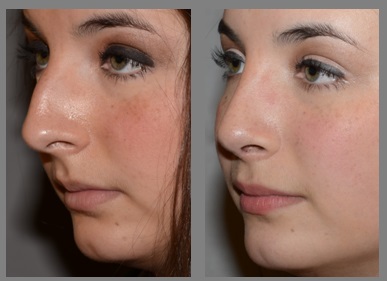 Rhinoplasty - Neal D. Goldman, M.D. - Facial Plastic Surgeon - Goldman Center for Facial Plastic Surgery
