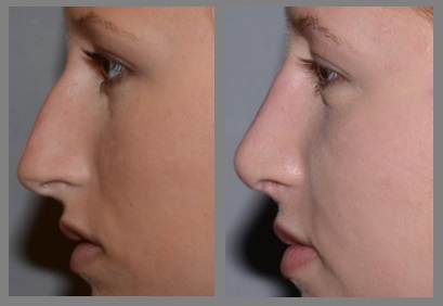 Rhinoplasty - Neal D. Goldman, M.D. - Facial Plastic Surgeon - Goldman Center for Facial Plastic Surgery