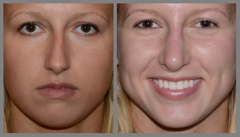 Rhinoplasty - Neal D. Goldman, M.D. - Facial Plastic Surgeon - Goldman Center for Facial Plastic Surgery