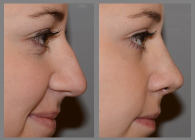 Rhinoplasty - Neal D. Goldman, M.D. - Facial Plastic Surgeon - Goldman Center for Facial Plastic Surgery