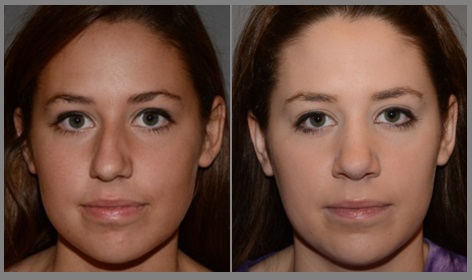 Rhinoplasty - Neal D. Goldman, M.D. - Facial Plastic Surgeon - Goldman Center for Facial Plastic Surgery