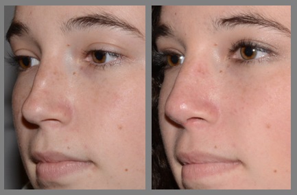 Rhinoplasty - Neal D. Goldman, M.D. - Facial Plastic Surgeon - Goldman Center for Facial Plastic Surgery