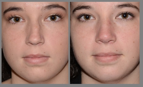 Rhinoplasty - Neal D. Goldman, M.D. - Facial Plastic Surgeon - Goldman Center for Facial Plastic Surgery